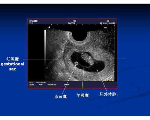 海南供卵得多久 海南试管婴儿专家医生有哪些？排名第一的是谁 ‘双顶径和心