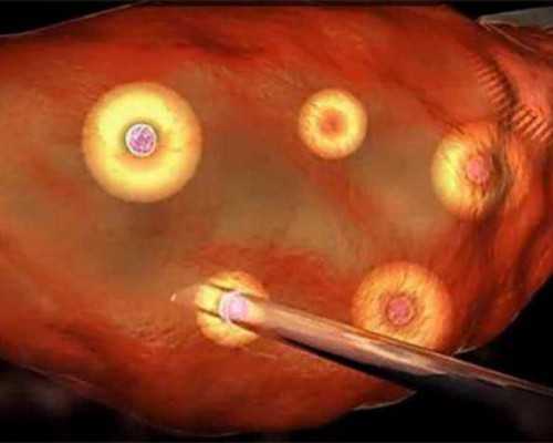 甘肃哪里可以冷冻卵子,甘肃冻卵的具体流程