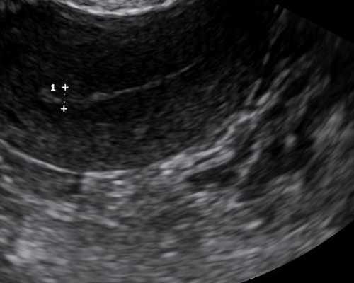两侧输卵管切除，甘肃庆阳有没有可做试管婴儿的医院