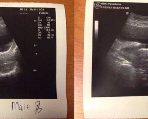 成都三代试管之前走过弯路，大龄备孕一定要多检查