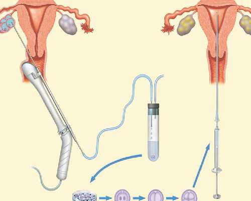 甘肃借卵生男孩 甘肃试管婴儿补贴多少？ ‘32周双顶径看男女’