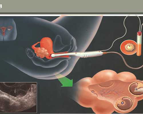 武汉代生多胞胎,武汉试管供卵（武汉最大的助孕公司）