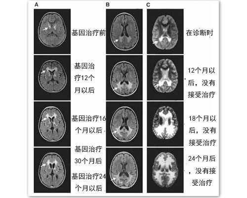 多囊卵巢2年，在甘肃酒泉做试管婴儿成功率有多高？