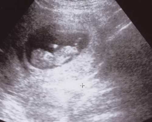 武汉代生三甲医院 武汉市做试管婴儿要多少钱 ‘彩超图判男女’