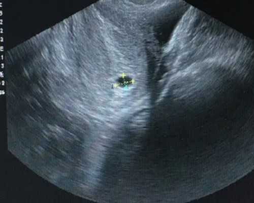 在甘肃张掖做助孕试管婴儿的成功率高不高？