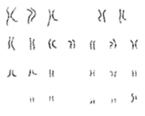 慢性胃炎可以喝鸡汤吗