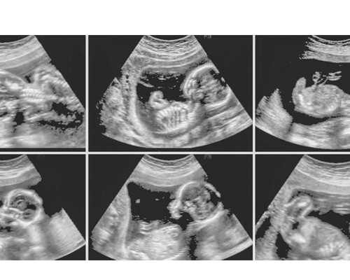 在甘肃张掖宫腺肌症做试管婴儿能有多大的成功率？